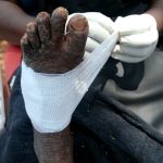 Bugisu Surpasses Busoga in Severe Jigger Infestations