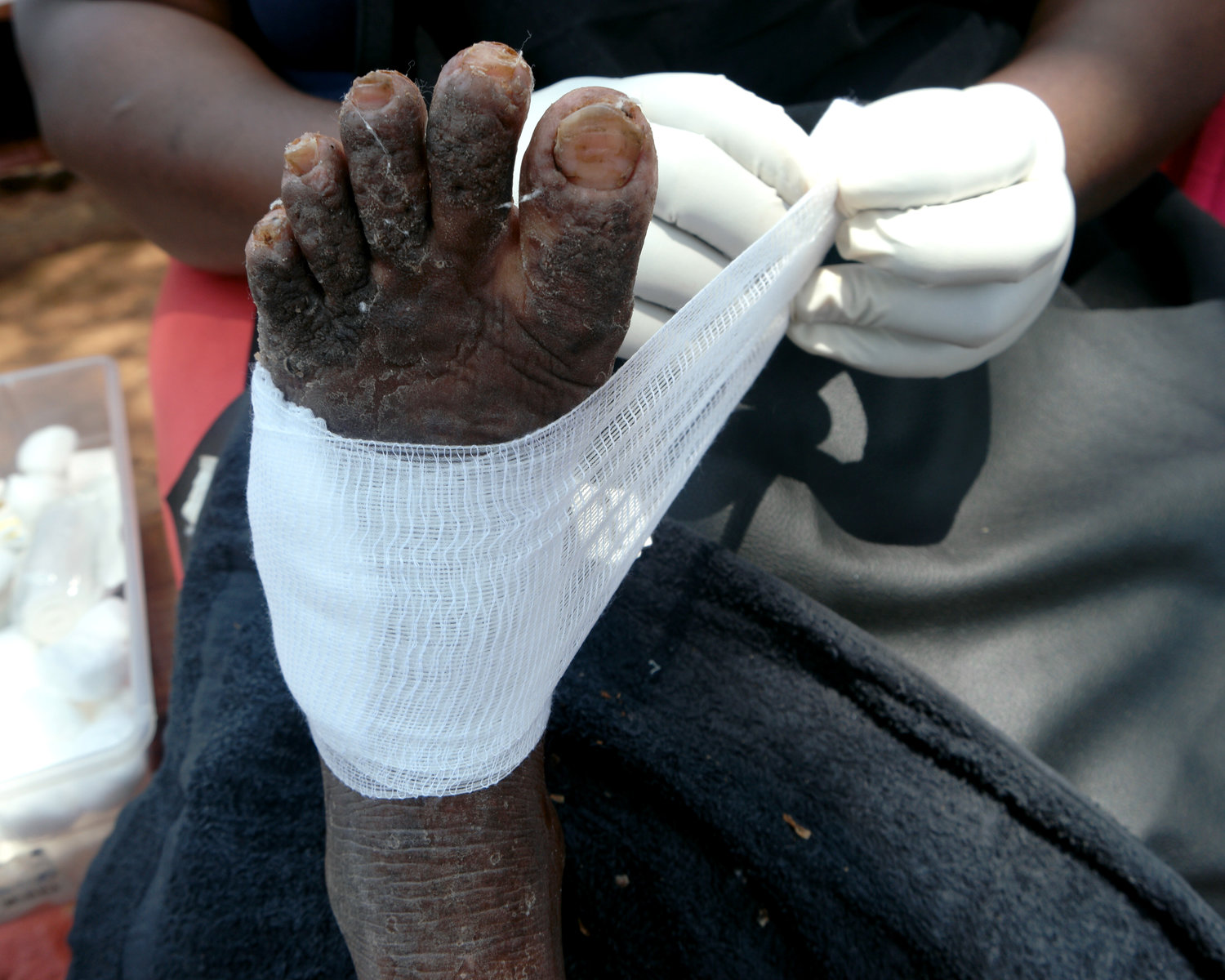Bugisu Surpasses Busoga in Severe Jigger Infestations