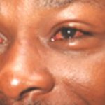 conjunctivitis-red-eye-disease-outbreak-confirmed-in-kampala-schools
