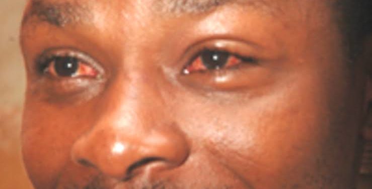 conjunctivitis-red-eye-disease-outbreak-confirmed-in-kampala-schools