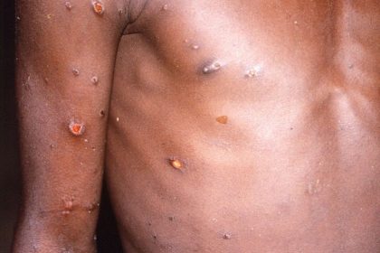 Uganda Reports Two New Monkeypox Cases