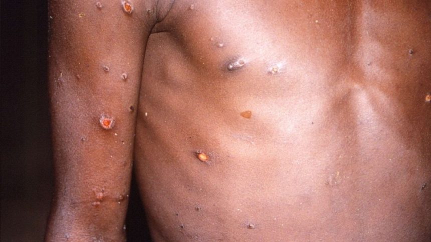 Uganda Reports Two New Monkeypox Cases