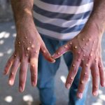 WHO Renames Monkeypox to Mpox to Combat Stigma