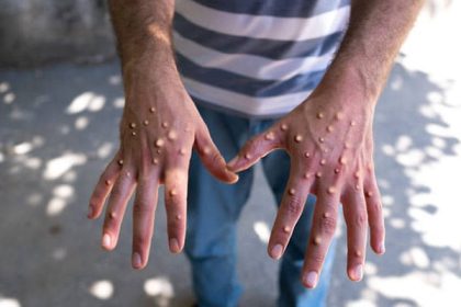 WHO Renames Monkeypox to Mpox to Combat Stigma