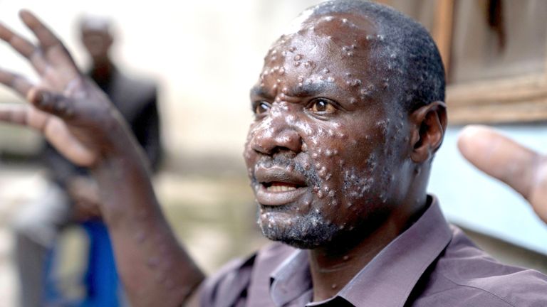 Mpox Case