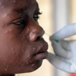 Mpox Detected in Masindi Prisons as Uganda Records 104 Infections