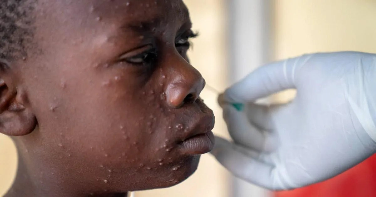 Mpox Detected in Masindi Prisons as Uganda Records 104 Infections