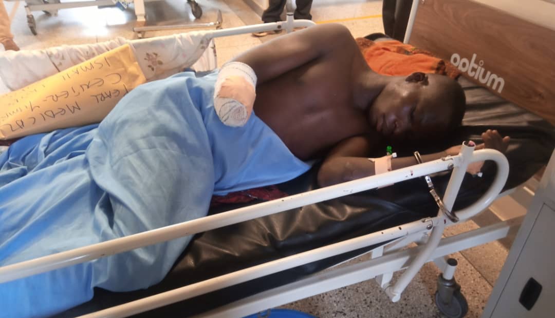 Residents of Etoko village in Maracha accused him of terrorizing their community from 2017 to 2023, leading to significant unrest. His criminal activities reportedly forced some residents to flee the area. Eyotre’s luck ran out on November 16, 2024, when he was caught stealing a goat in Owapi village, Terego District. A mob apprehended him, cutting off his right hand and inflicting deep machete wounds on his left leg.